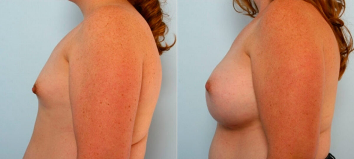 Breast Augmentation before and after photos in Houston, TX, Patient 25209