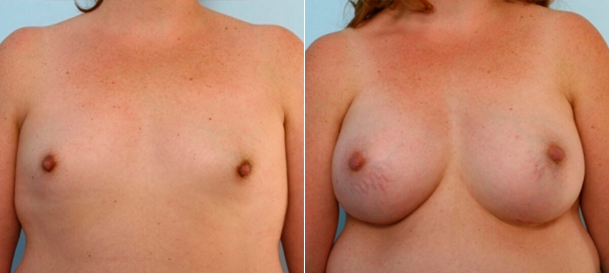 Breast Augmentation before and after photos in Houston, TX, Patient 25209