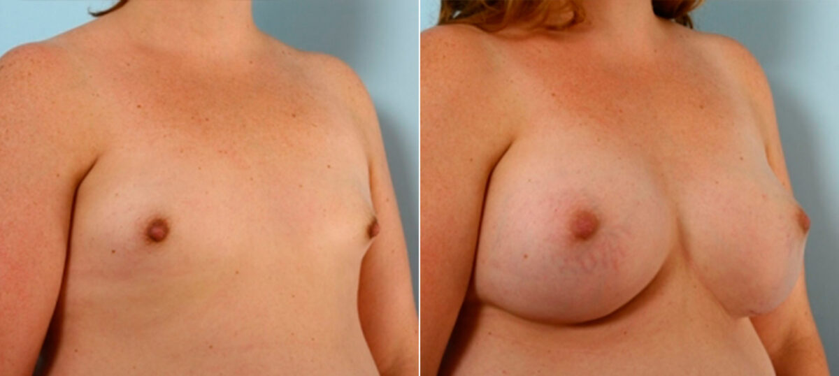 Breast Augmentation before and after photos in Houston, TX, Patient 25209