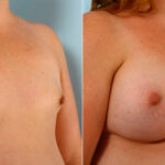 Breast Augmentation before and after photos in Houston, TX, Patient 25209