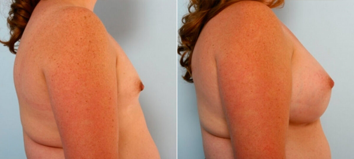 Breast Augmentation before and after photos in Houston, TX, Patient 25209