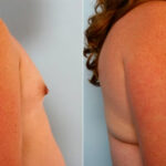 Breast Augmentation before and after photos in Houston, TX, Patient 25209