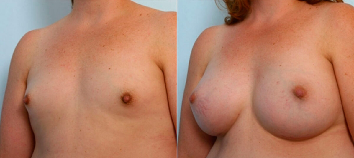 Breast Augmentation before and after photos in Houston, TX, Patient 25209