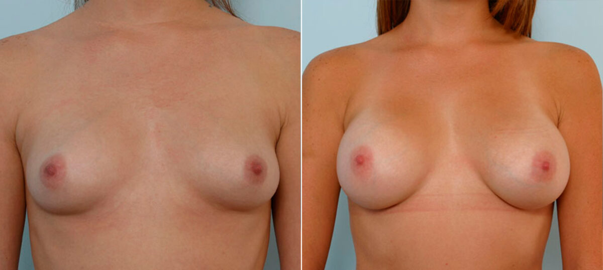 Breast Augmentation before and after photos in Houston, TX, Patient 25220