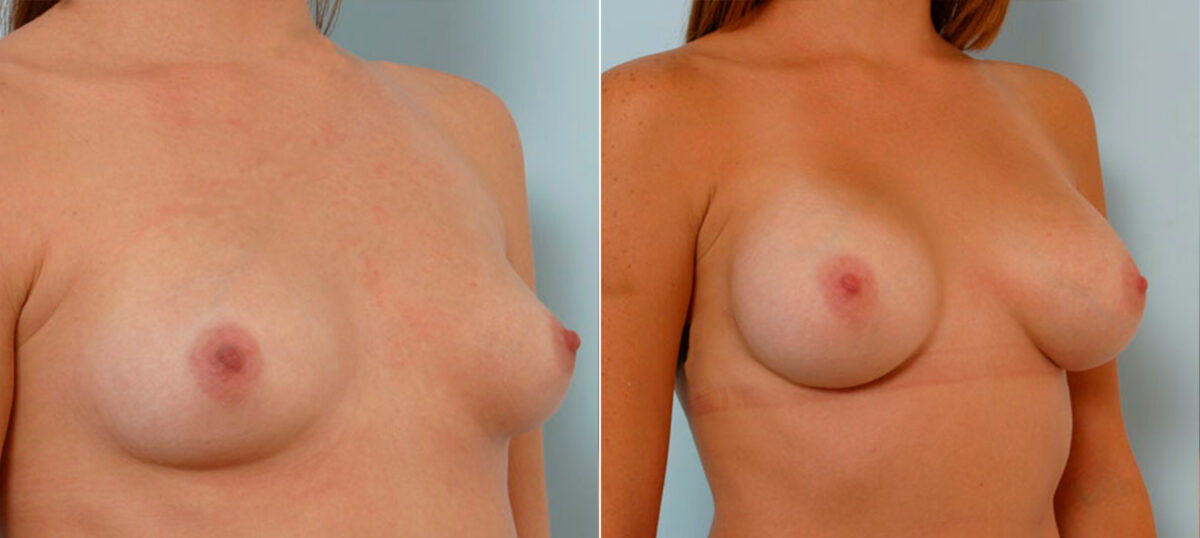 Breast Augmentation before and after photos in Houston, TX, Patient 25220