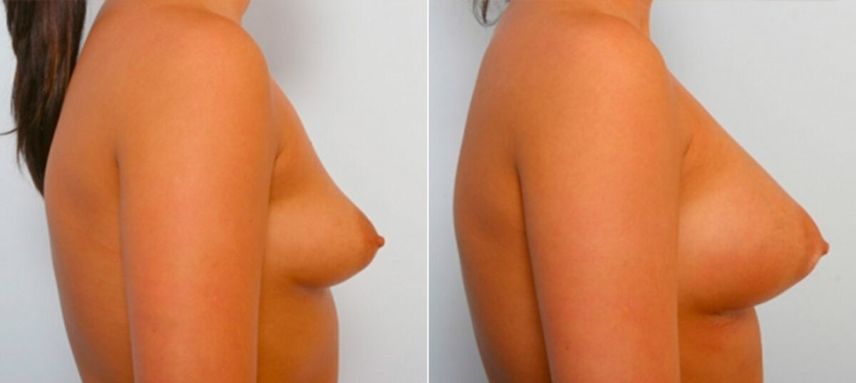 Breast Augmentation before and after photos in Houston, TX, Patient 25231