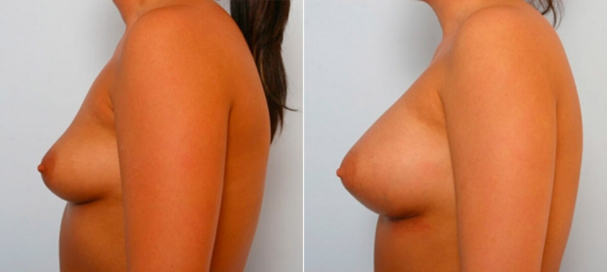 Breast Augmentation before and after photos in Houston, TX, Patient 25231