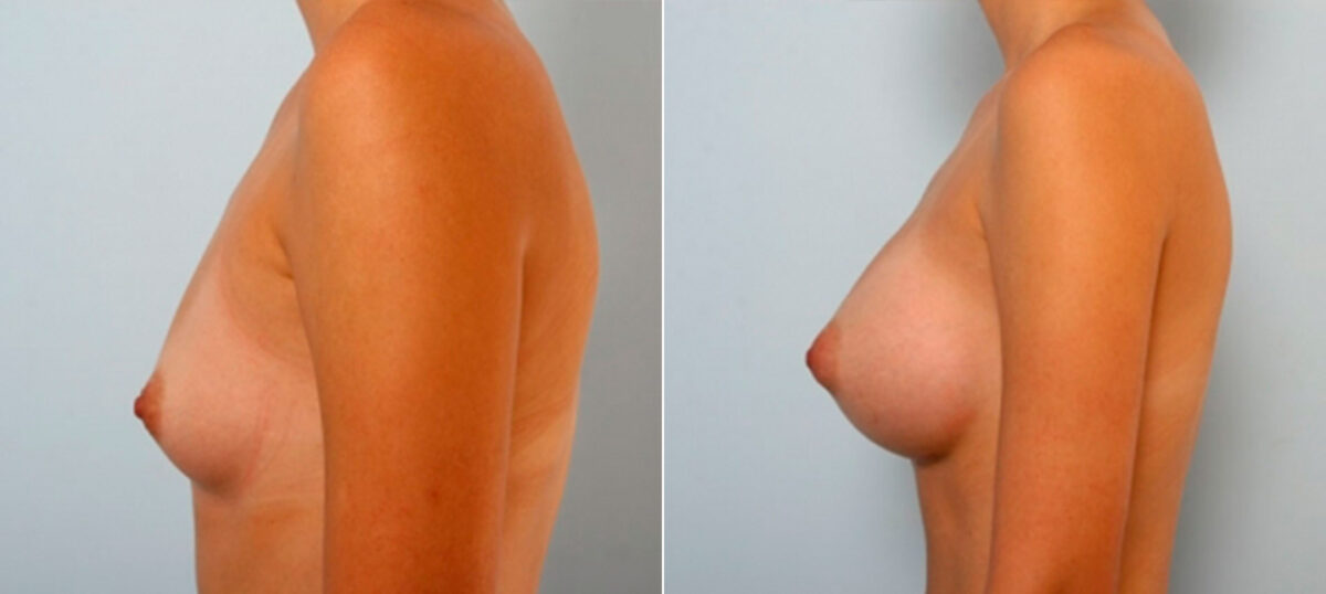 Breast Augmentation before and after photos in Houston, TX, Patient 25242