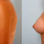 Breast Augmentation before and after photos in Houston, TX, Patient 25242