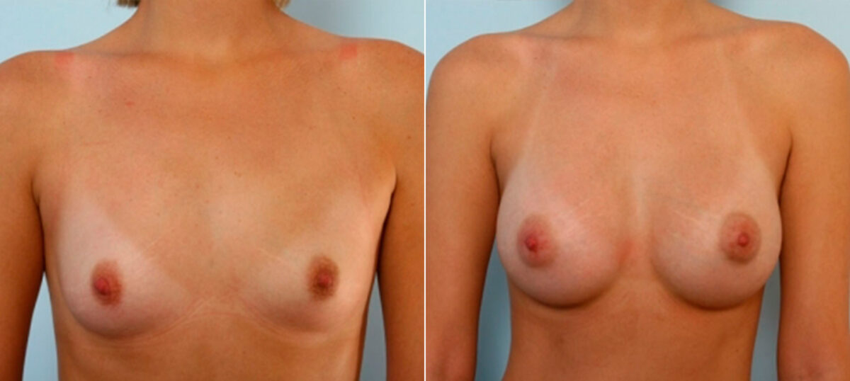 Breast Augmentation before and after photos in Houston, TX, Patient 25242