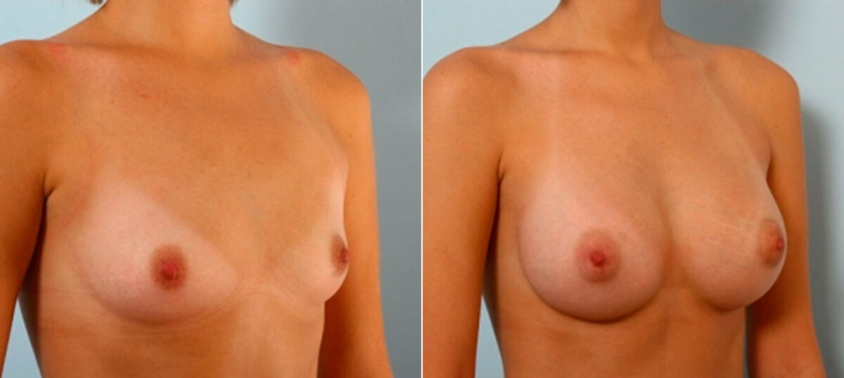 Breast Augmentation before and after photos in Houston, TX, Patient 25242