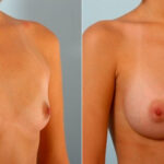 Breast Augmentation before and after photos in Houston, TX, Patient 25242