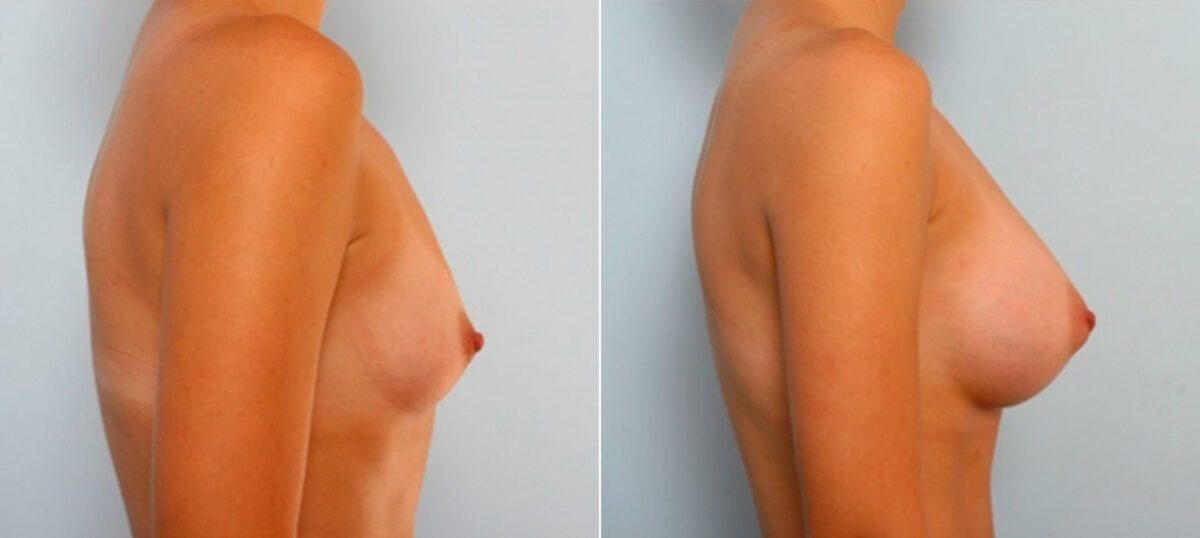 Breast Augmentation before and after photos in Houston, TX, Patient 25242