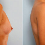 Breast Augmentation before and after photos in Houston, TX, Patient 25242