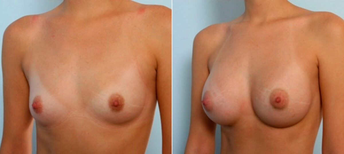 Breast Augmentation before and after photos in Houston, TX, Patient 25242