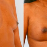 Breast Augmentation before and after photos in Houston, TX, Patient 25253