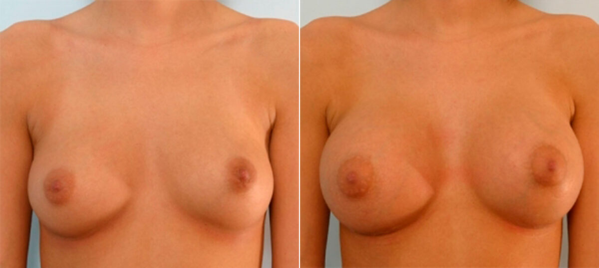 Breast Augmentation before and after photos in Houston, TX, Patient 25264