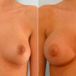 Breast Augmentation before and after photos in Houston, TX, Patient 25264