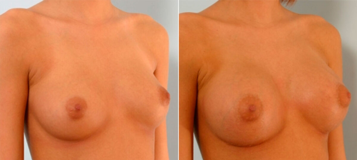 Breast Augmentation before and after photos in Houston, TX, Patient 25264