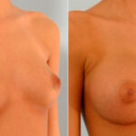 Breast Augmentation before and after photos in Houston, TX, Patient 25264