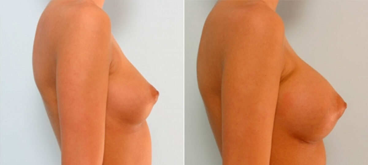 Breast Augmentation before and after photos in Houston, TX, Patient 25264