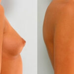 Breast Augmentation before and after photos in Houston, TX, Patient 25264