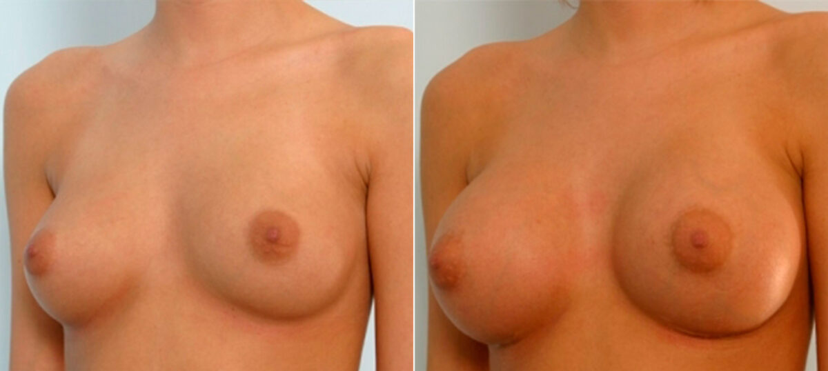 Breast Augmentation before and after photos in Houston, TX, Patient 25264