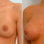 Breast Augmentation before and after photos in Houston, TX, Patient 25264