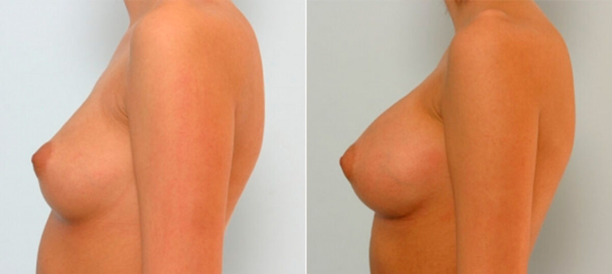Breast Augmentation before and after photos in Houston, TX, Patient 25264