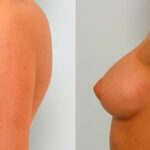 Breast Augmentation before and after photos in Houston, TX, Patient 25264