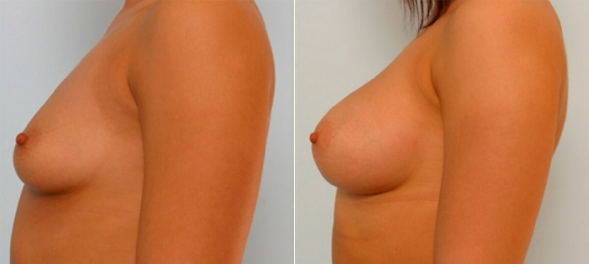 Breast Augmentation before and after photos in Houston, TX, Patient 25275