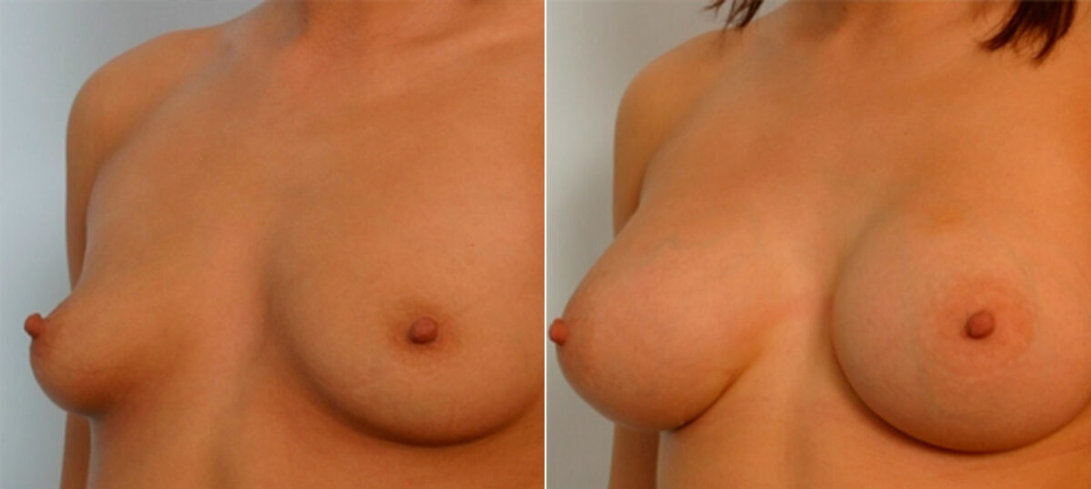 Breast Augmentation before and after photos in Houston, TX, Patient 25275