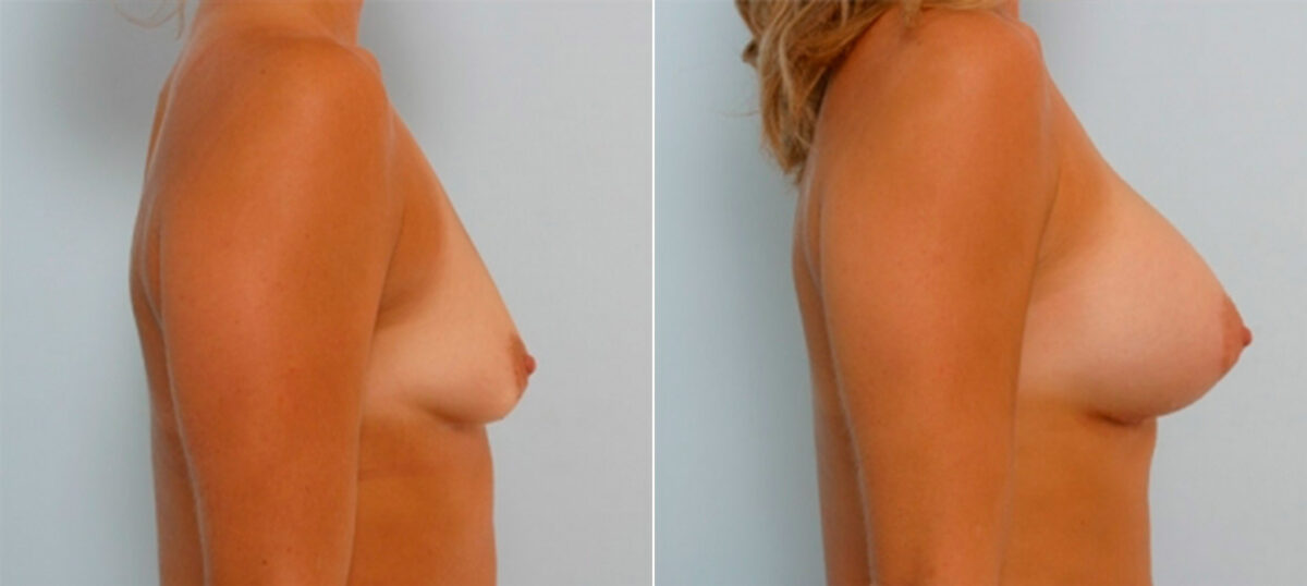 Breast Augmentation before and after photos in Houston, TX, Patient 25286