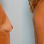 Breast Augmentation before and after photos in Houston, TX, Patient 25286