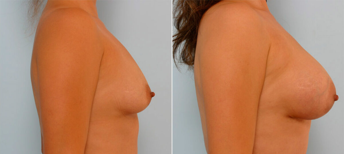 Breast Augmentation before and after photos in Houston, TX, Patient 25293