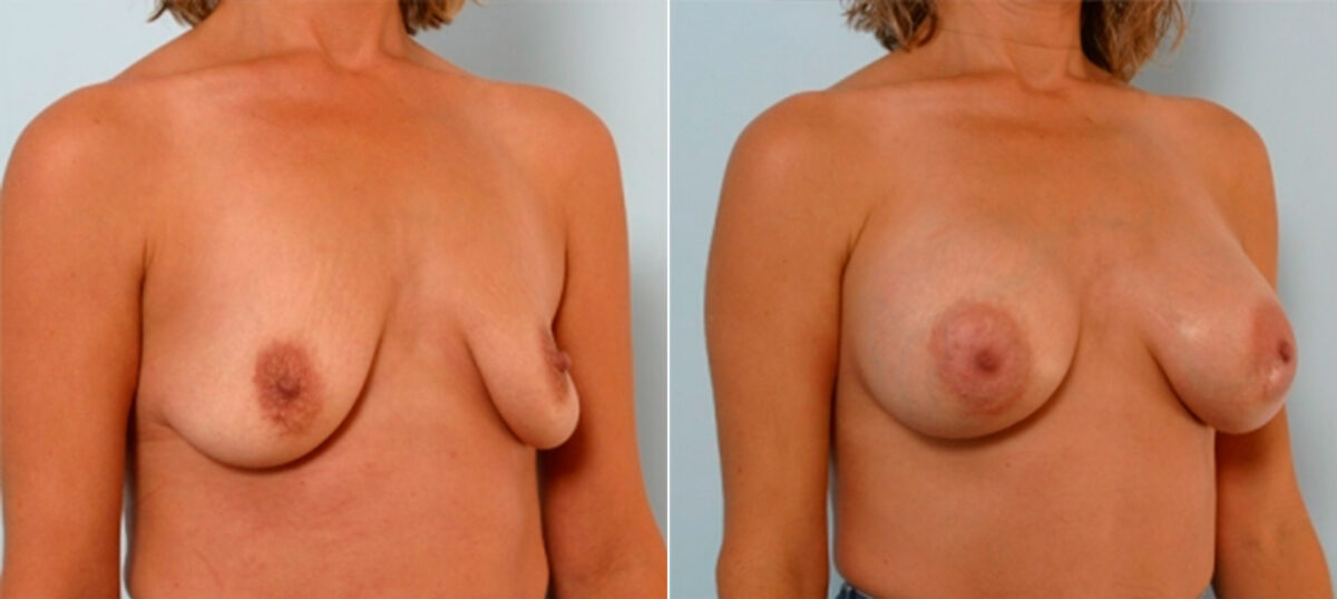 Breast Augmentation before and after photos in Houston, TX, Patient 25300