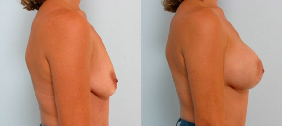 Breast Augmentation before and after photos in Houston, TX, Patient 25300