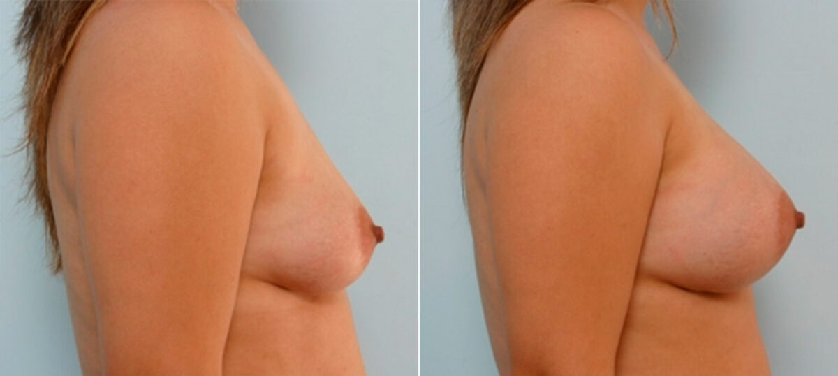 Breast Augmentation before and after photos in Houston, TX, Patient 25307