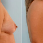 Breast Augmentation before and after photos in Houston, TX, Patient 25307