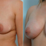 Breast Augmentation before and after photos in Houston, TX, Patient 25307