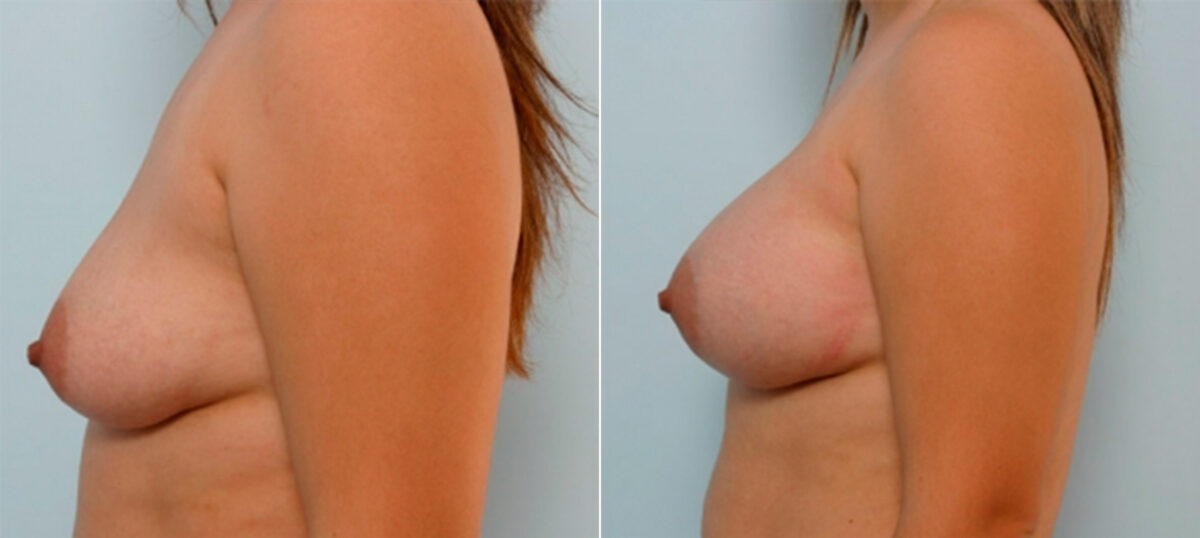 Breast Augmentation before and after photos in Houston, TX, Patient 25307