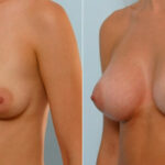 Breast Augmentation before and after photos in Houston, TX, Patient 25316