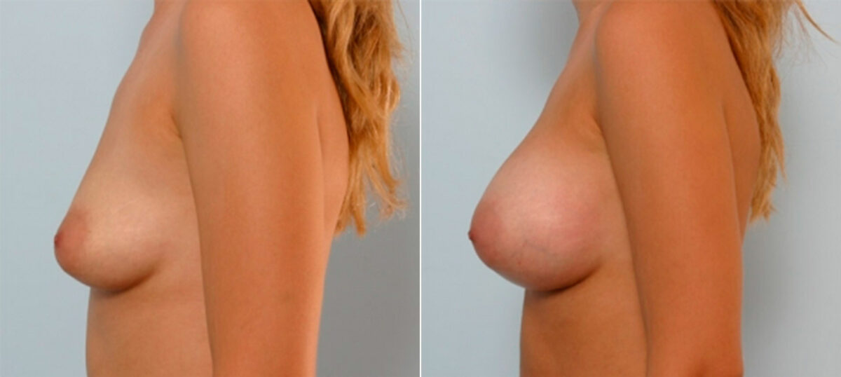 Breast Augmentation before and after photos in Houston, TX, Patient 25316