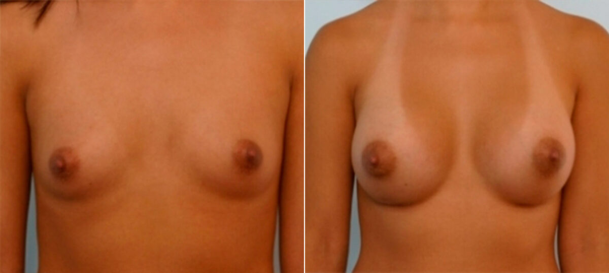 Breast Augmentation before and after photos in Houston, TX, Patient 25327