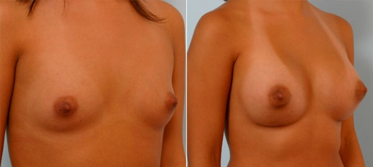 Breast Augmentation before and after photos in Houston, TX, Patient 25327