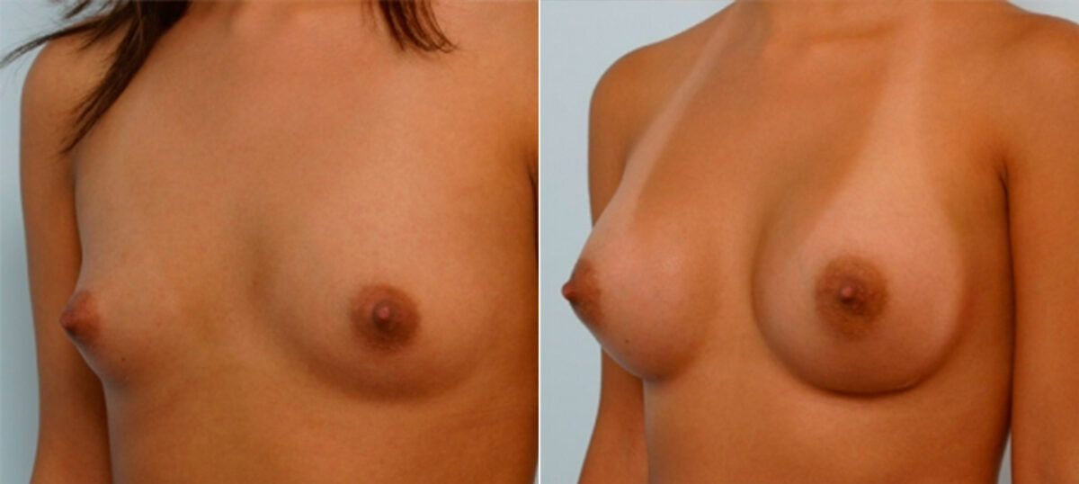 Breast Augmentation before and after photos in Houston, TX, Patient 25327