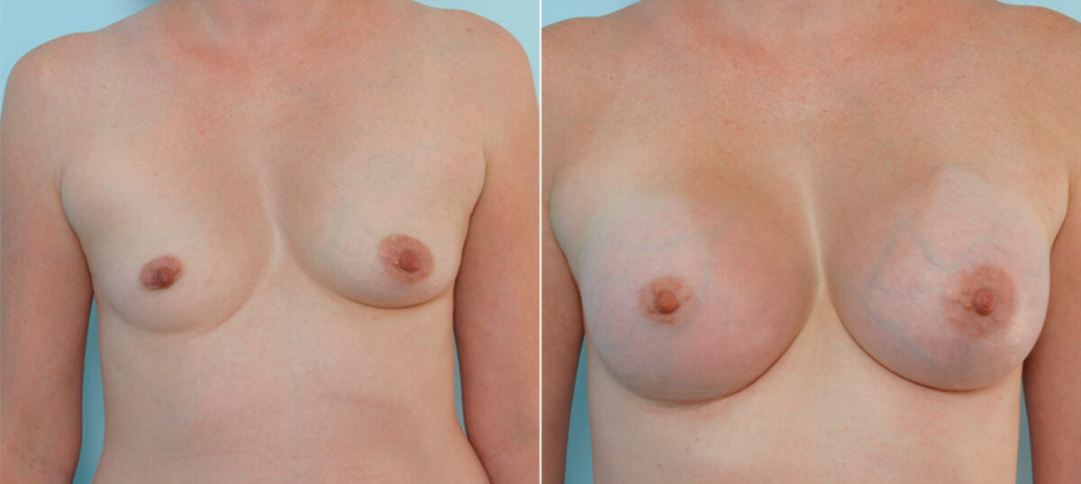 Breast Augmentation before and after photos in Houston, TX, Patient 25338