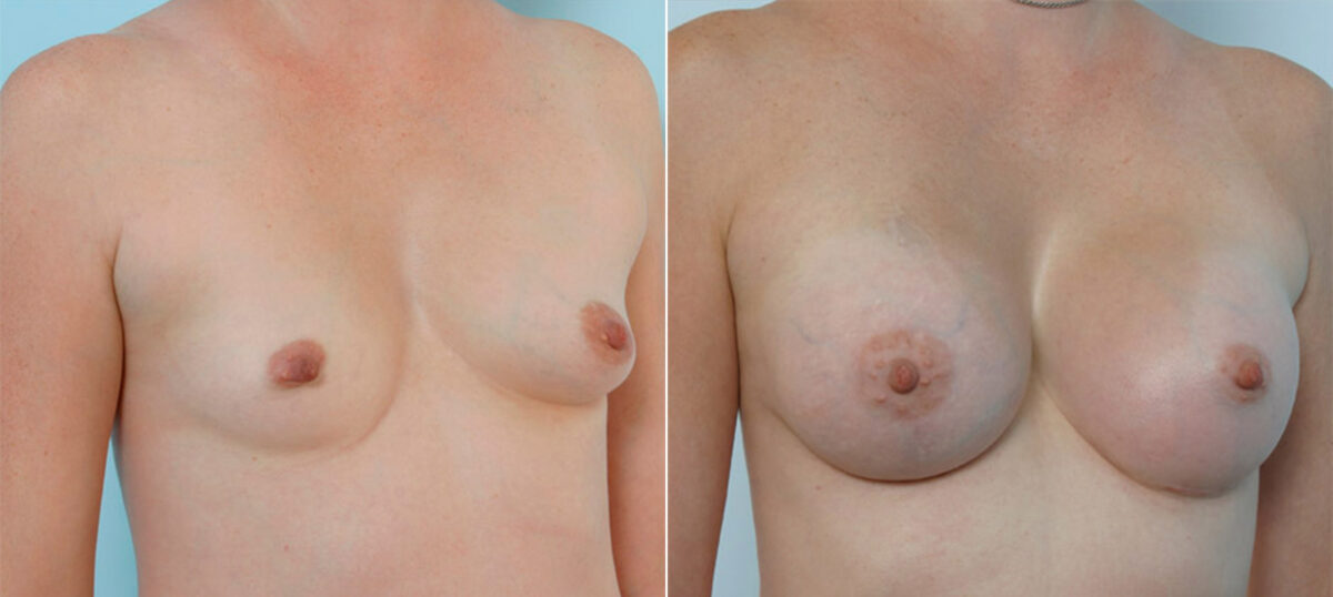 Breast Augmentation before and after photos in Houston, TX, Patient 25338