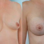 Breast Augmentation before and after photos in Houston, TX, Patient 25338