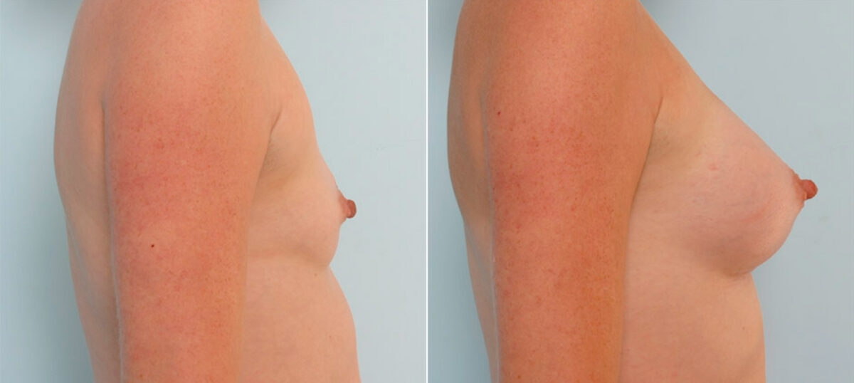 Breast Augmentation before and after photos in Houston, TX, Patient 25338